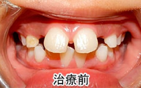 正中離開、乱杭歯の治療例：お子さん治療前